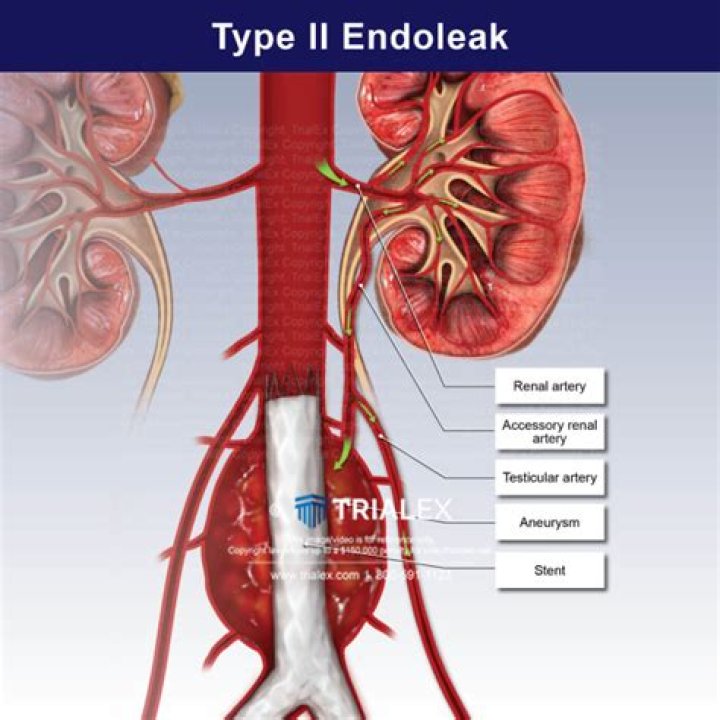 What is Type II endoleak?